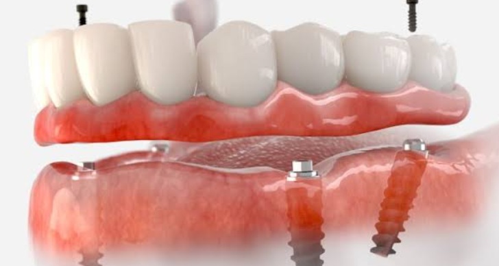 All-on-X vs. Traditional Dentures: Which Is Right for You?