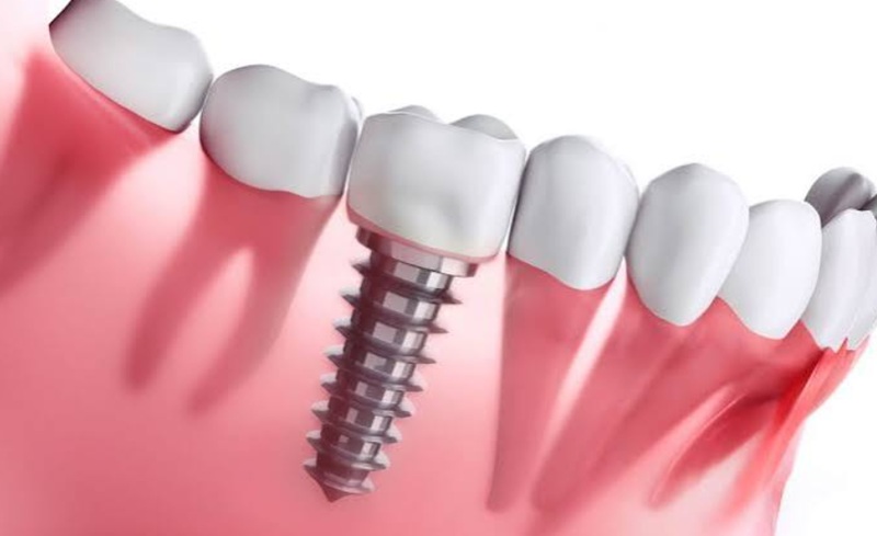 7 Signs You’re a Good Candidate for Dental Implants