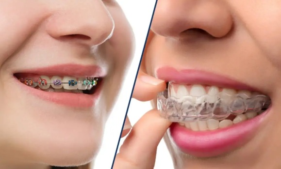 Invisalign vs Traditional Braces: Which Is Right for You?