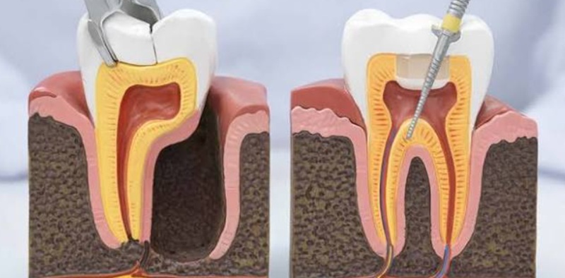 Root Canal vs. Tooth Extraction: Which Is Better for Your Tooth?