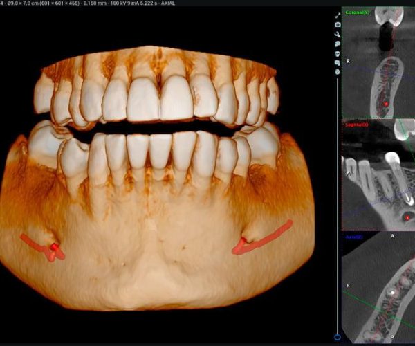 All-on-X Dental Implants Dentist in Rockville, MD