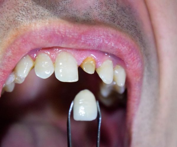 Dental Crowns Dentist Rockville