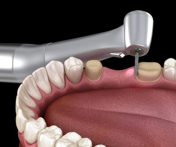 Dental Crowns Dentist in Rockville