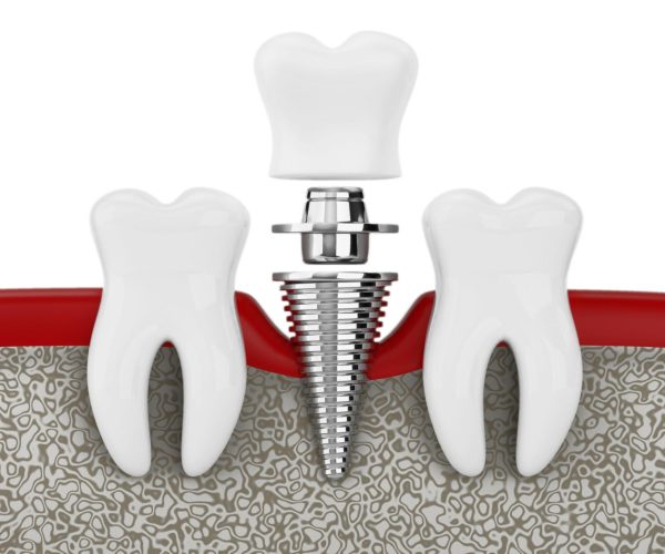 Dental Implants in Rockville, MD