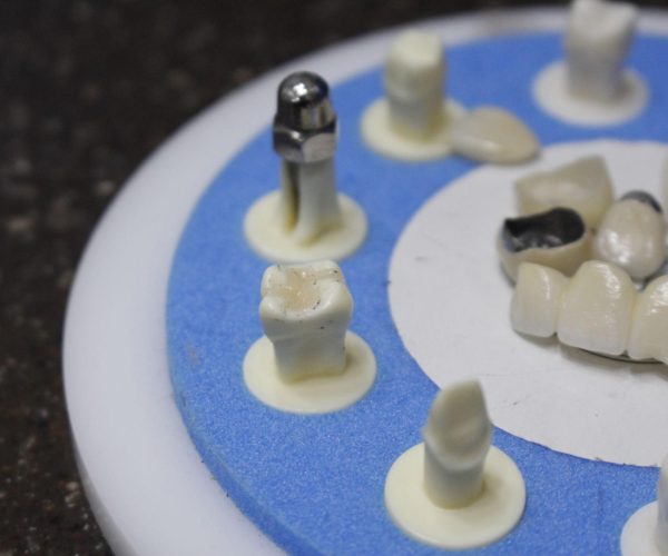 Dental Implants