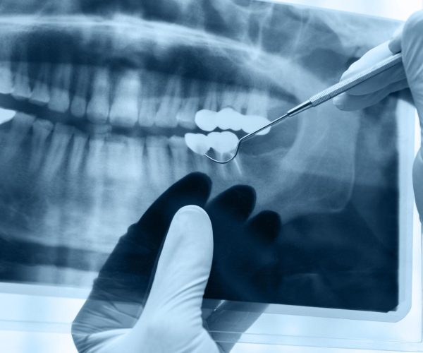 Digital X-Rays in Rockville, MD