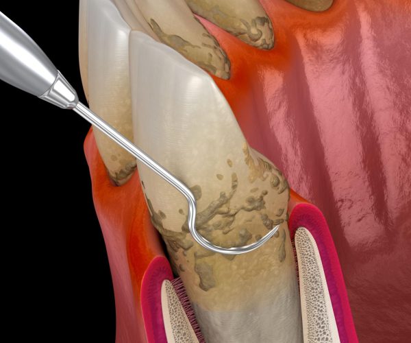 Gum Disease Treatment Rockville, MD