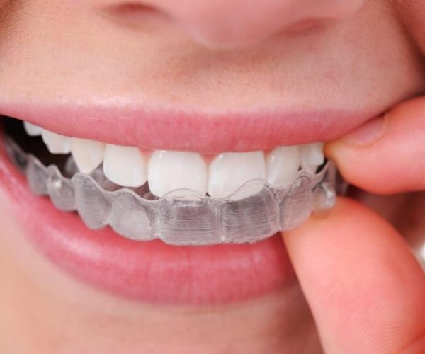 Invisalign in Rockville, MD