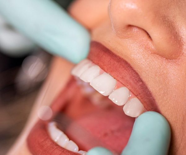 Oral Cancer Screening in Rockville, MD