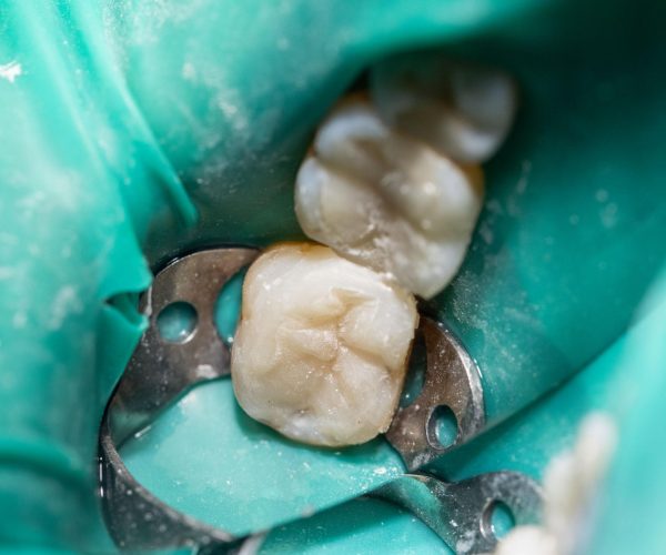 Root Canal Therapy in Rockville, MD