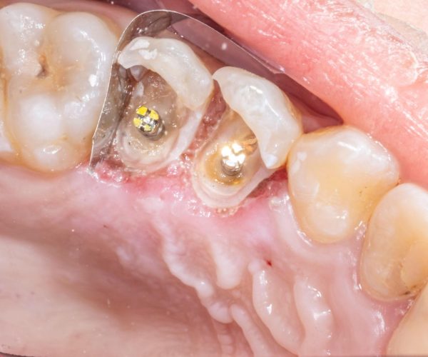 Root Canal Therapy in Rockville