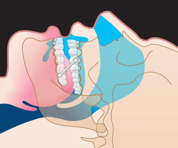 Sleep Apnea Dentist in Rockville, MD