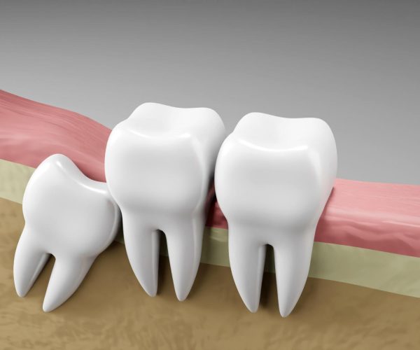 Tooth Extraction in Rockville, MD